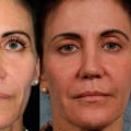 Reduction in Wrinkles and Fine Lines: The Benefits of Dermal Fillers