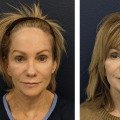 Ablative Laser Resurfacing (CO2 Laser): Everything You Need to Know