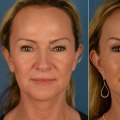 Face Lift (Rhytidectomy): All You Need To Know