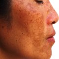 Changes in Skin Pigmentation: Risks of Laser Skin Resurfacing Treatments