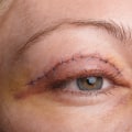 Eyelid Surgery: All You Need to Know