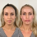 Restored Volume to the Face and Cheeks