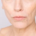 Understanding Smoker's Lines: Causes and Treatment Options in Chiswick