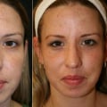 Reduction in Wrinkles, Age Spots, and Sun Damage: Benefits of Laser Skin Resurfacing Treatments