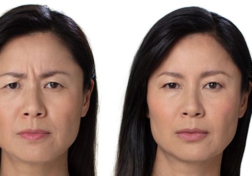 Reducing Wrinkles and Fine Lines with Botox Injections