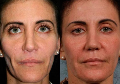 Reduction in Wrinkles and Fine Lines: The Benefits of Dermal Fillers