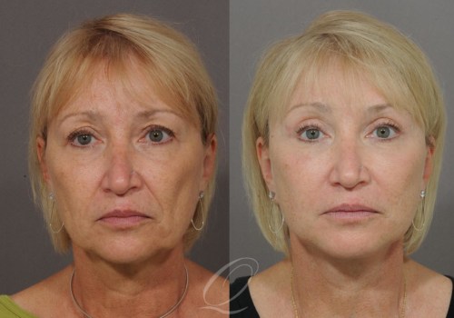 Facelift: A Comprehensive Overview