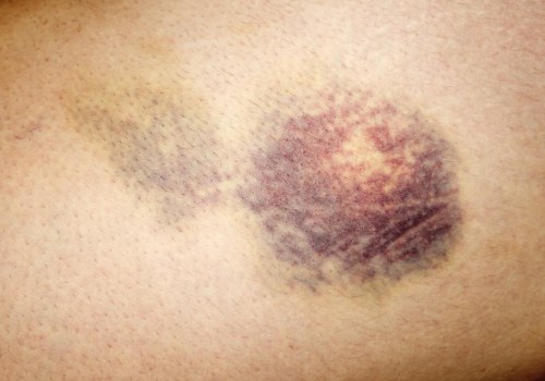 Managing Swelling and Bruising After Surgery