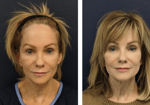 Ablative Laser Resurfacing (CO2 Laser): Everything You Need to Know