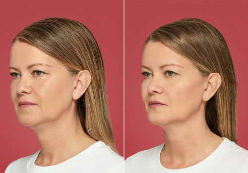 Restoration of Facial Volume and Contours: Benefits of Botox Injections