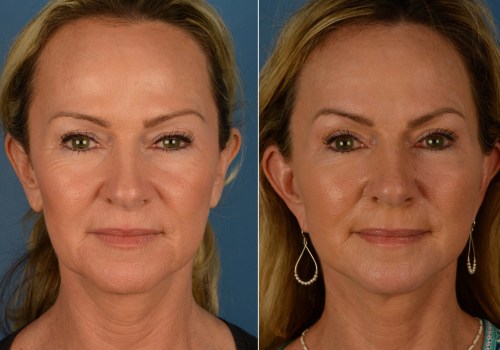 Face Lift (Rhytidectomy): All You Need To Know