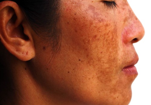Changes in Skin Pigmentation: Risks of Laser Skin Resurfacing Treatments