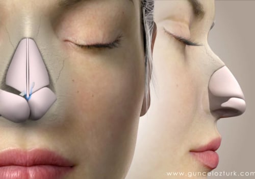 Understanding Nose Surgery (Rhinoplasty)