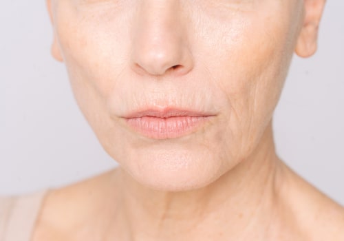 Understanding Smoker's Lines: Causes and Treatment Options in Chiswick