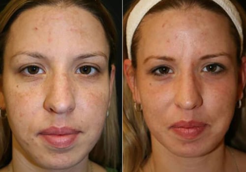 Reduction in Wrinkles, Age Spots, and Sun Damage: Benefits of Laser Skin Resurfacing Treatments