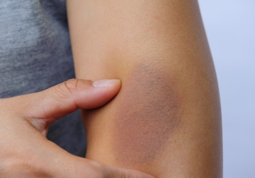 Managing Swelling and Bruising After Treatment